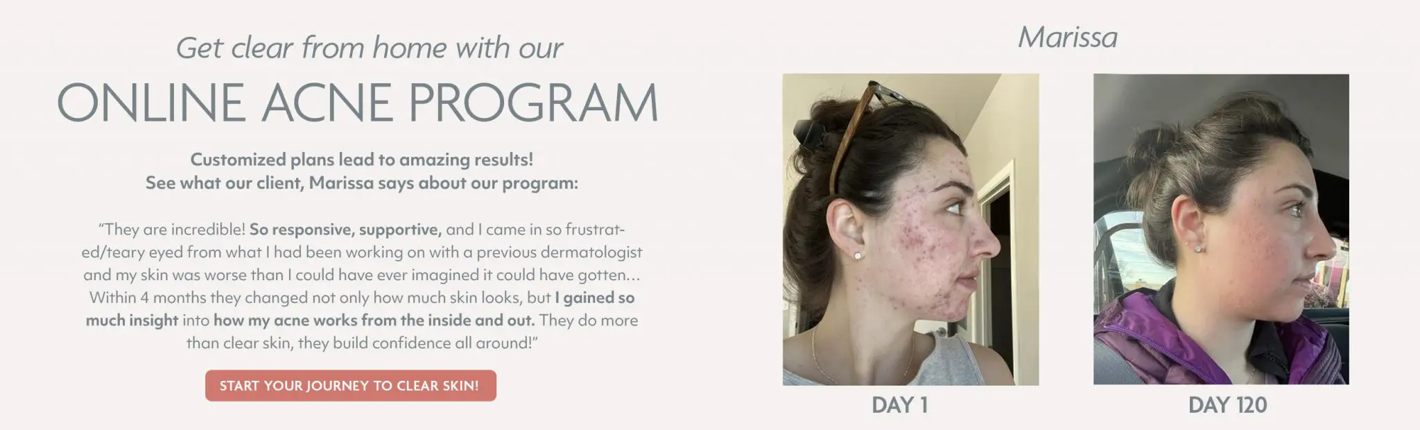 Online Acne Program