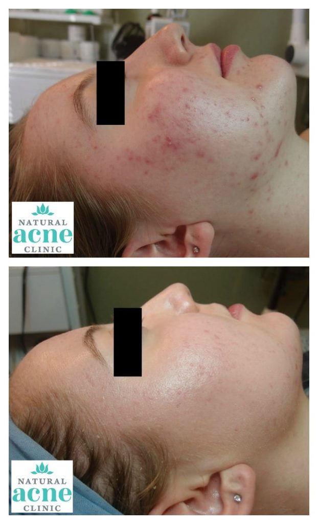 Acne Scarring Treatment Options