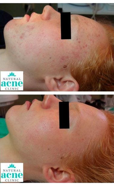 the natural acne clinic