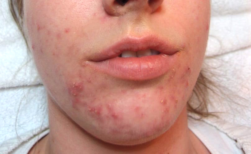 What Causes Post-Pill Acne? — The Clinic Skin Health