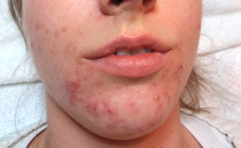 Hormonal Acne Neck