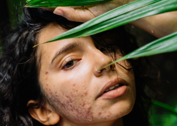 Don't let stubborn acne keep you from feeling confident. Discover the hidden causes of your treatment failure and how to solve them.