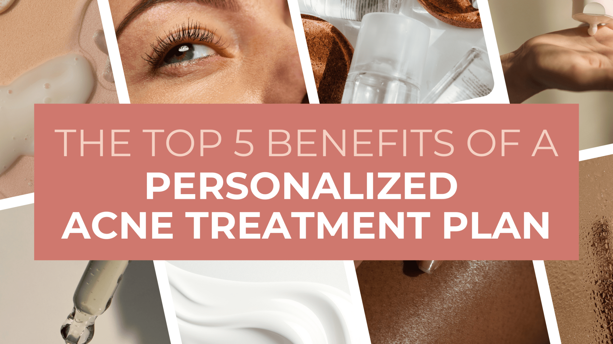 The Top 5 Benefits of a Personalized Acne Treatment Plan 
