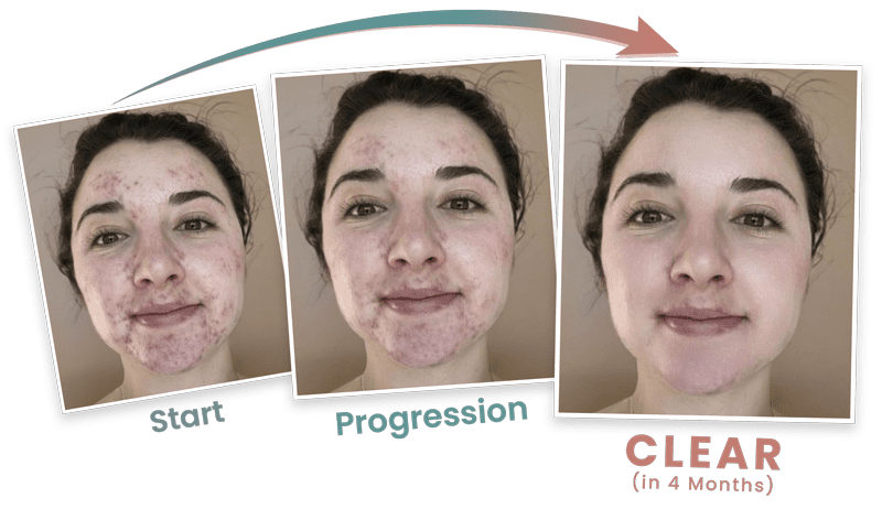 Acne-Clearing Visualizer