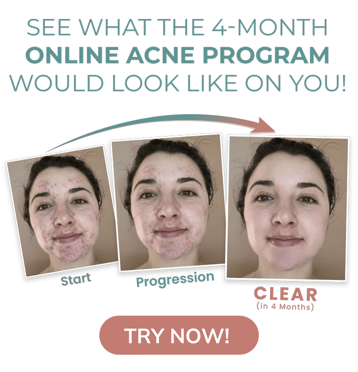 AI Acne-Clearing Visualizer